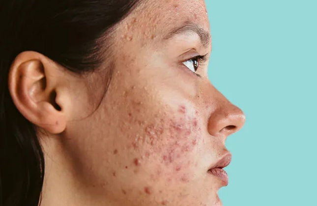 Drs Leenarts Day & Night Cream Oily/Acne-Prone Skin - 50ml