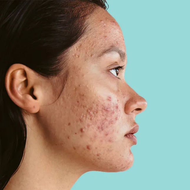 Drs Leenarts Pimple Spot Lotion - 15ml